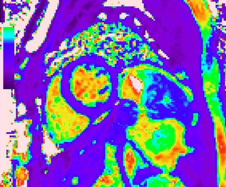A T1-rho relaxation-time map of a cardiac MRI slice, with the left ventricle showing as a bright yellow ring.